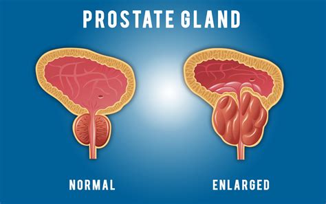 bhp prostate meaning